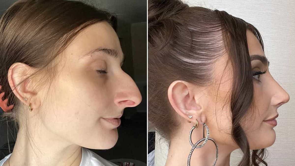 Molestata da quando aveva 14 anni a causa del suo naso, risparmia 10.000 euro